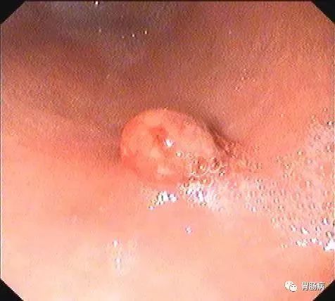 胃息肉可以除根吗,胃息肉能去根吗