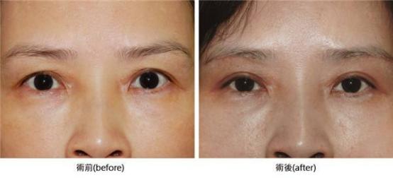 埋线双眼皮一般能保持几年,埋线双眼皮10年效果图