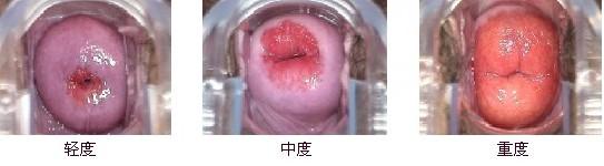 宫颈糜烂leep刀手术影响怀孕吗,宫颈糜烂能误诊宫颈疱疹吗