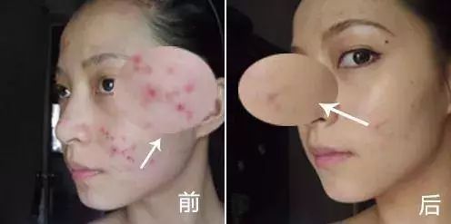 好物去黑头祛痘,去黑头粉刺面霜