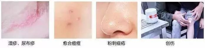 好物去黑头祛痘,去黑头粉刺面霜