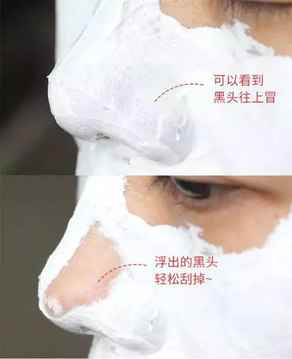 好物去黑头祛痘,去黑头粉刺面霜