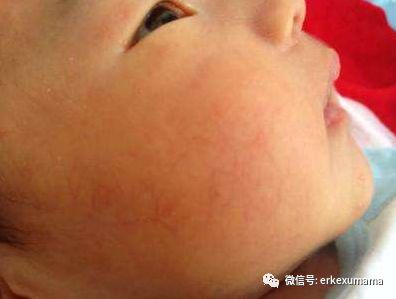 小孩脸上有一个红点带血丝,小孩脸上有颗红痣还有血丝