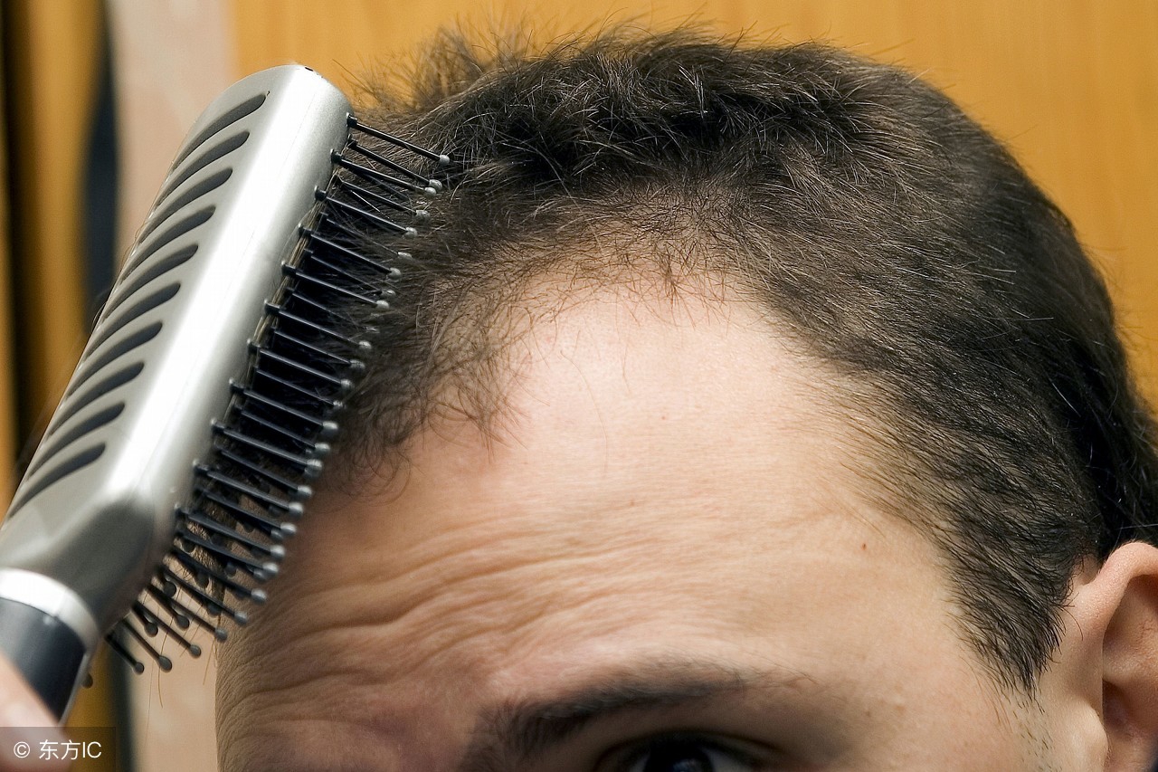 脂溢性皮炎脱发可以染发吗,脂溢性皮炎和雄性激素脱发