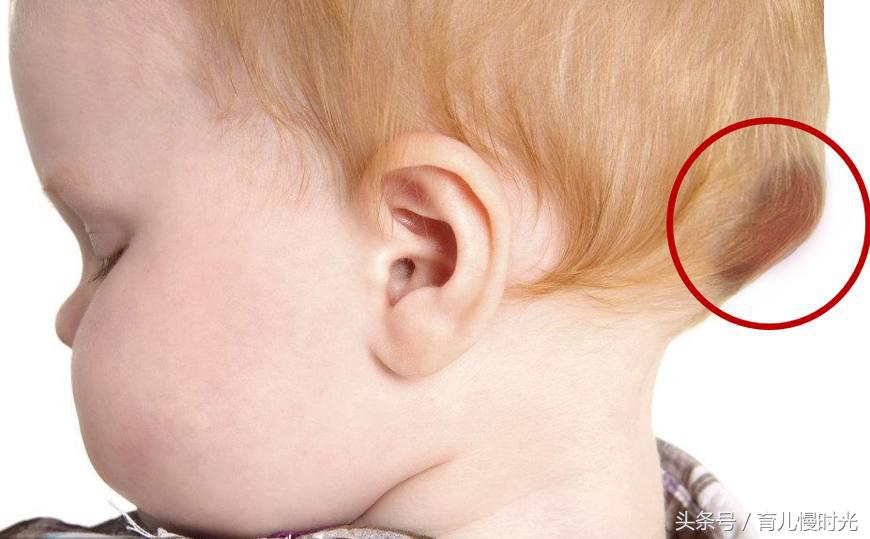 孩子摔倒碰到头后需要注意什么,小孩子摔倒头部起包怎么处理