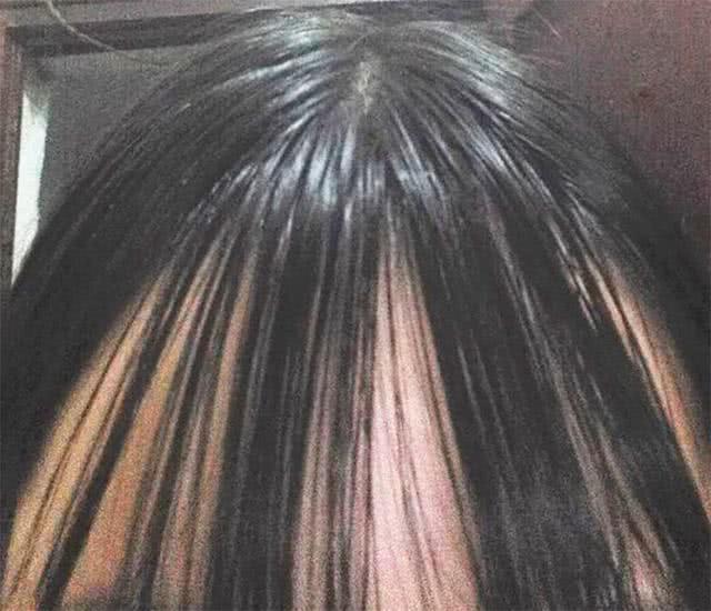 学会这6招家里再也没有螨虫,怎样才能把头上的螨虫弄下来