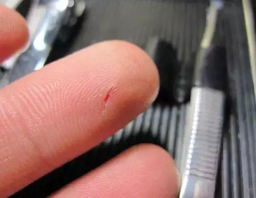 恐怖！株洲大叔脚趾划破皮险些丧命！