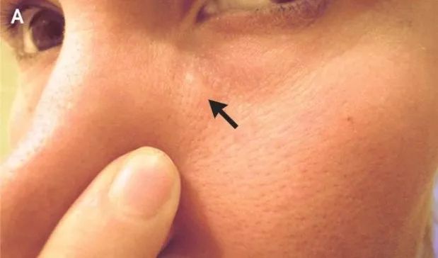 为什么被蚊子叮了会出一个包,蚊子叮的包会不会有寄生虫