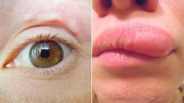 为什么被蚊子叮了会出一个包,蚊子叮的包会不会有寄生虫