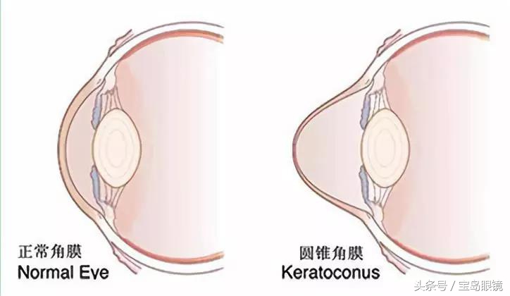 圆锥角膜图像解析,圆锥角膜怎么才能看清