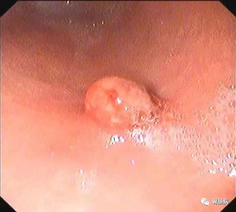 胃息肉是怎样形成的要注意什么,胃息肉长了很多怎么办