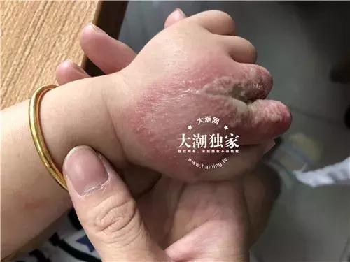 隐翅虫咬人后起水泡挤爆会传染吗,隐翅虫咬人症状图