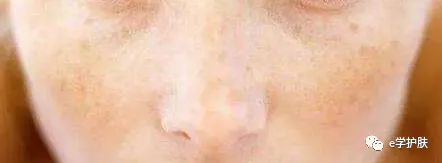 痘印和色斑怎么区别,痘印和斑点肌肤怎么护理