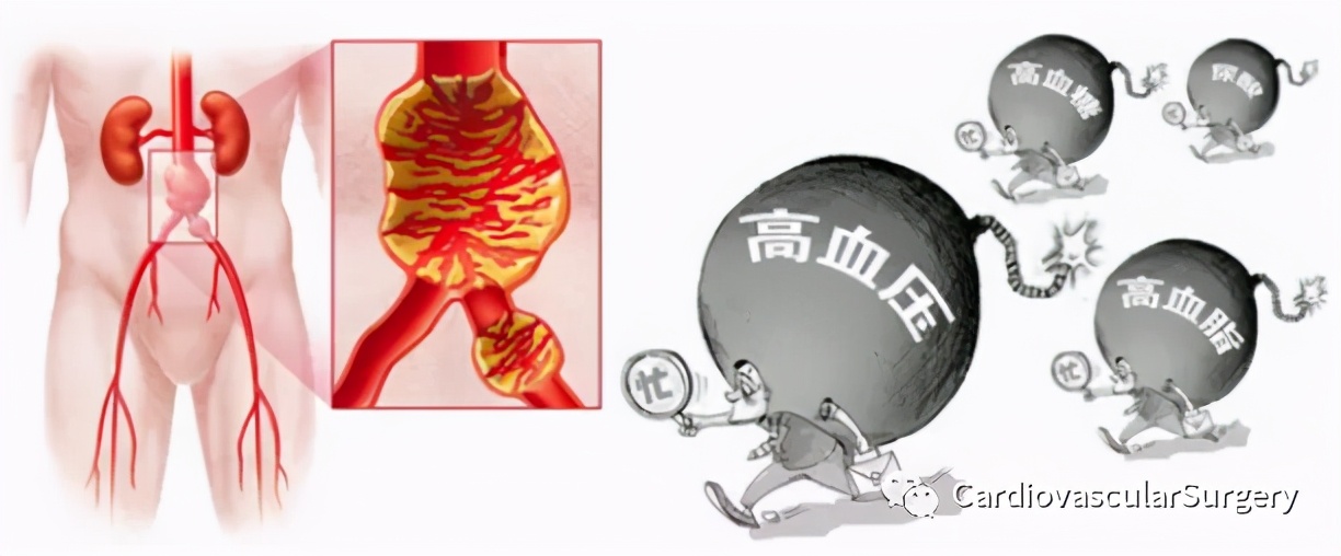 腹主动脉瘤做微创手术的条件,腹主动脉瘤5cm保守治疗能恢复吗