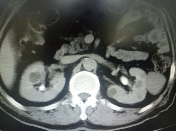 “一箭多星”治愈七旬大伯难言的“疼”