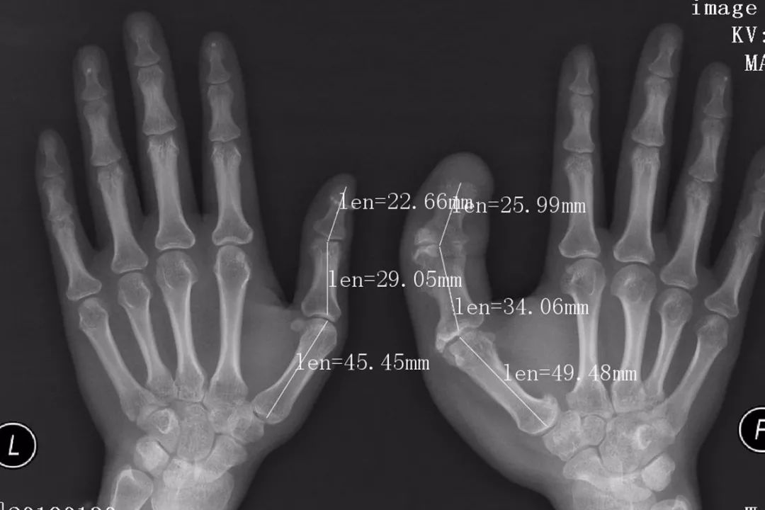 妙龄女子患上巨指症，专家画了一张图让她很惊喜！