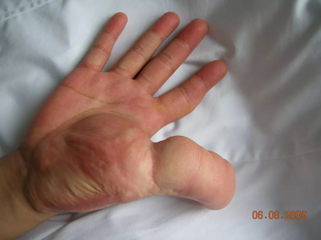 妙龄女子患上巨指症，专家画了一张图让她很惊喜！