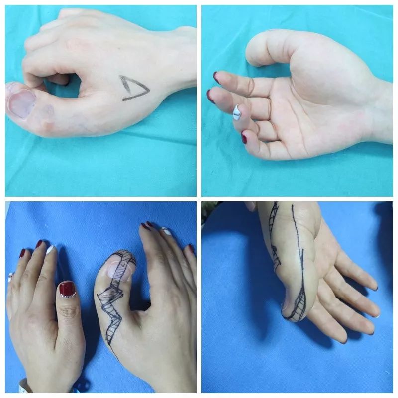 妙龄女子患上巨指症，专家画了一张图让她很惊喜！