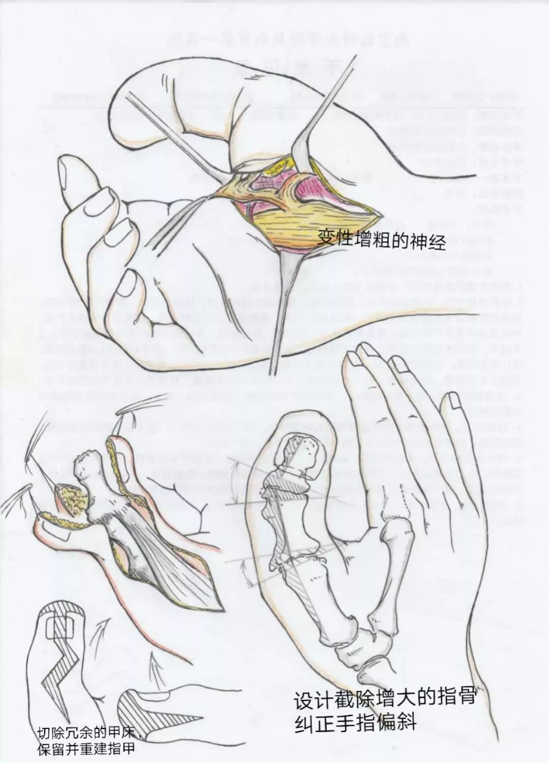 妙龄女子患上巨指症，专家画了一张图让她很惊喜！