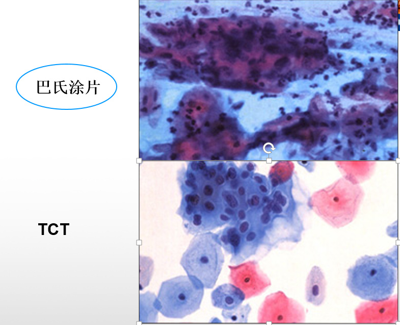 预防宫颈癌要做什么检查,预防宫颈癌几年检查一次