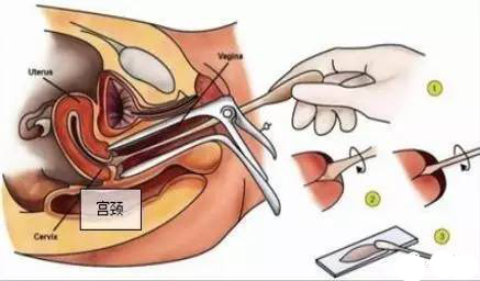 预防宫颈癌要做什么检查,预防宫颈癌几年检查一次