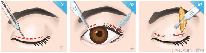 埋线双眼皮一般能保持几年,埋线双眼皮10年效果图