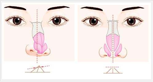 慢性鼻窦炎治疗法，想让孩子变聪明的母亲—《针通经络》之三十七