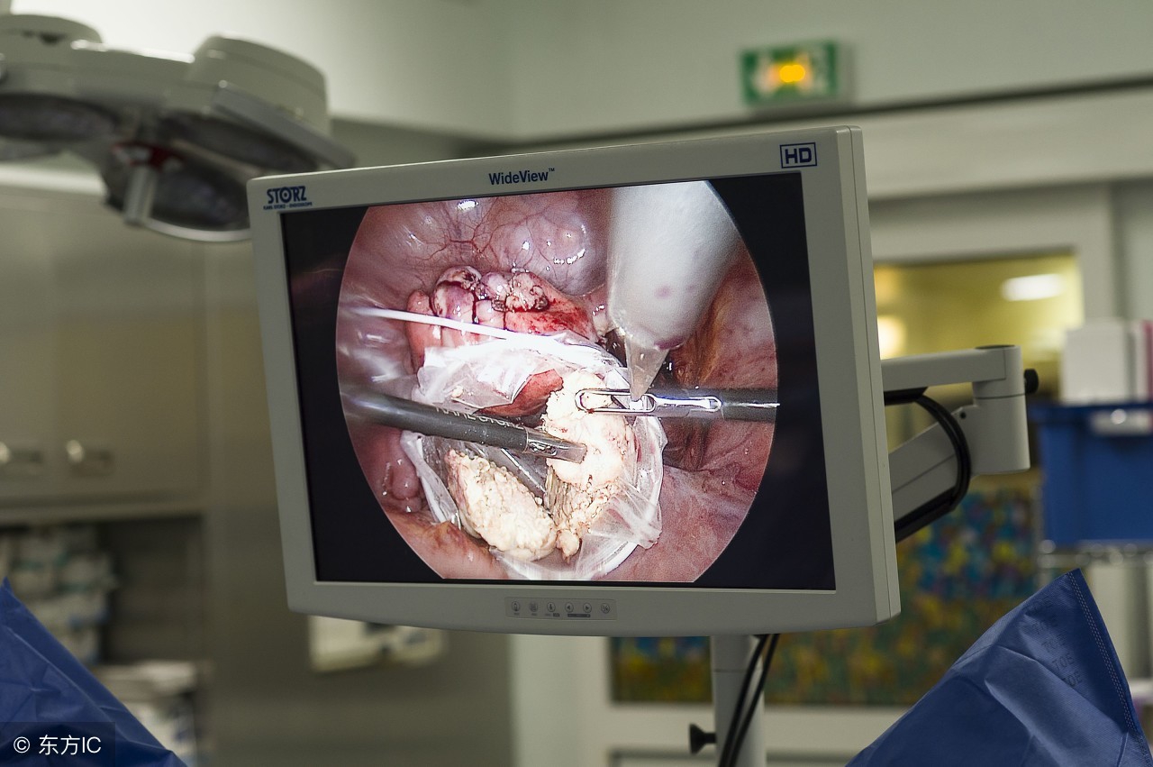 巧克力囊肿腹腔镜手术后休息多久,巧克力囊肿过了45岁还需要手术吗