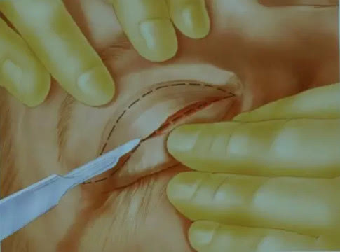 双眼皮手术过程中有烧焦味,埋线定位无痕双眼皮手术过程