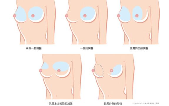 如何拥有完美的胸型,怎么样才能有更好的胸部