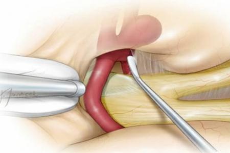 脑动脉瘤与其他肿瘤的区别,颅内动脉瘤爆炸怎么办