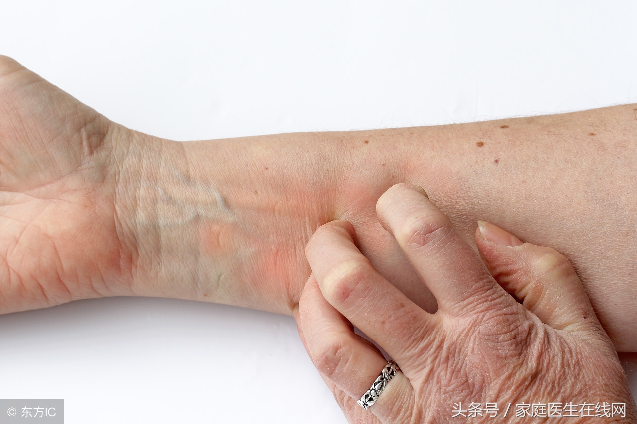 一到夏季湿疹就复发反复一直不好,湿疹一到夏天就复发是怎么回事