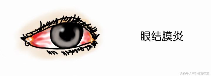 宝宝眼睛脓性分泌物是哪种,儿童沙眼衣原体感染的症状表现