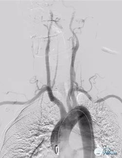 基底动脉闭合手术,基底动脉闭塞取栓一直昏睡