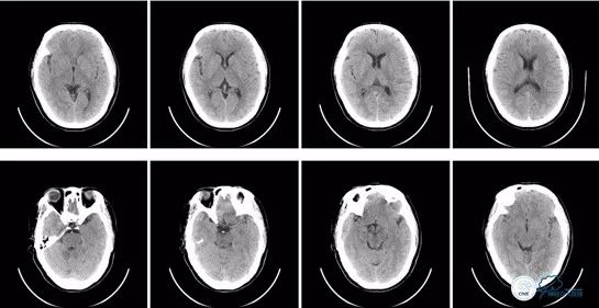 基底动脉闭合手术,基底动脉闭塞取栓一直昏睡
