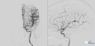 基底动脉闭合手术,基底动脉闭塞取栓一直昏睡