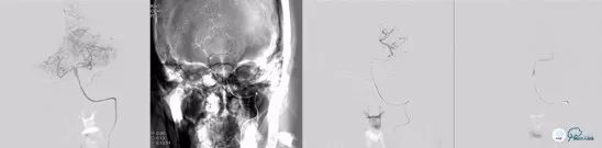 基底动脉闭合手术,基底动脉闭塞取栓一直昏睡