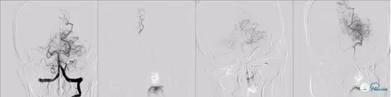 基底动脉闭合手术,基底动脉闭塞取栓一直昏睡