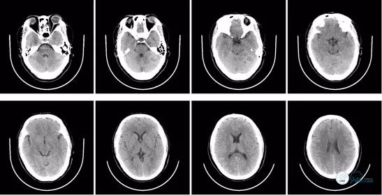 基底动脉闭合手术,基底动脉闭塞取栓一直昏睡