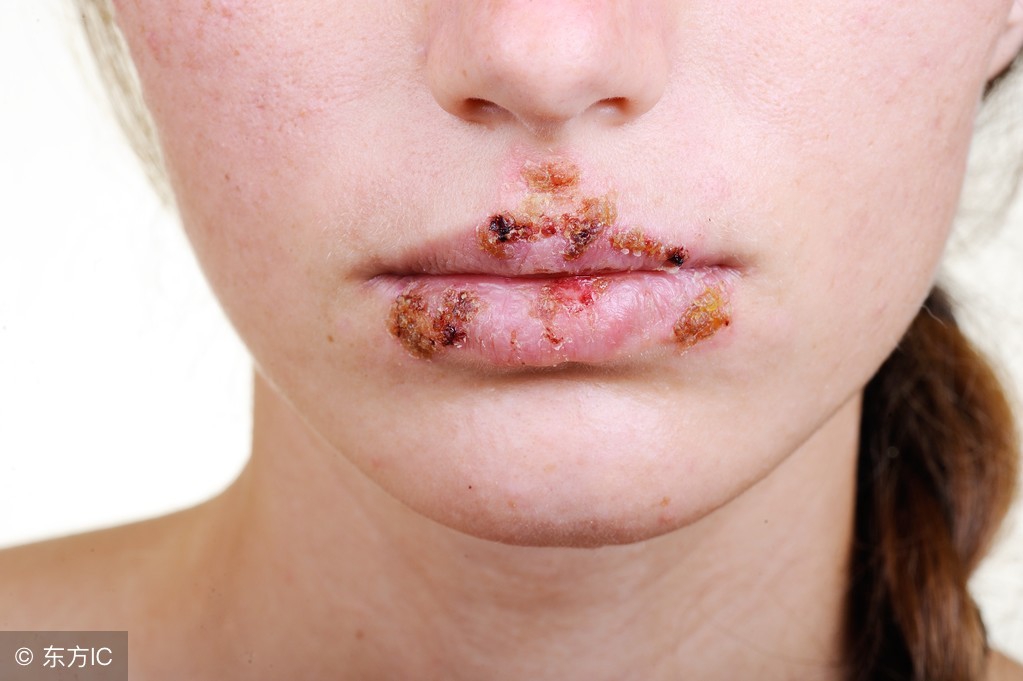 嘴巴长疱疹能亲嘴吗,嘴巴长疱疹千万别亲宝宝