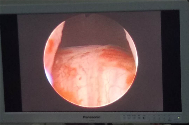 前列腺增生经尿道微创电切手术,前列腺增生加膀胱结石微创手术