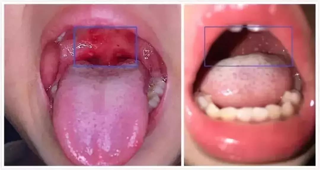 手足口病怎么预防和处理,手足口病怎么教家长护理和预防