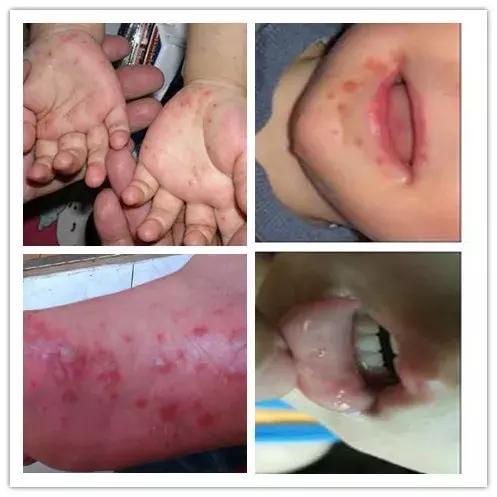 手足口病怎么预防和处理,手足口病怎么教家长护理和预防