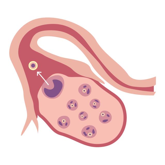 捐卵有多可怕?多少年轻女孩差点把命都搭进去了!