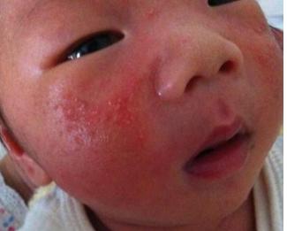 宝宝满头都是湿疹怎么解决,宝宝四肢出现很多小红疹怎么办