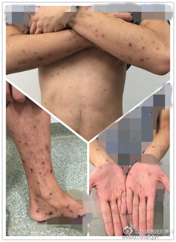 梅毒治疗好后还传染吗注意什么,梅毒治疗过程中注意事项