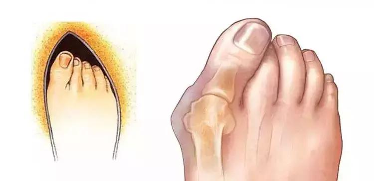 畸形脚型,看脚型分辨你适合穿怎样的鞋子
