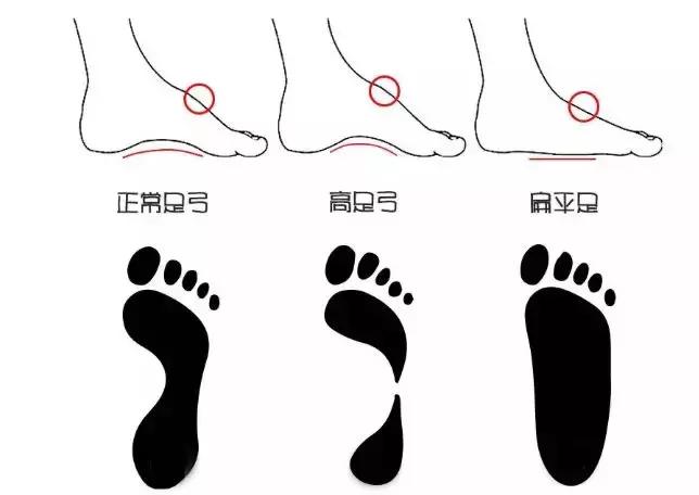 畸形脚型,看脚型分辨你适合穿怎样的鞋子