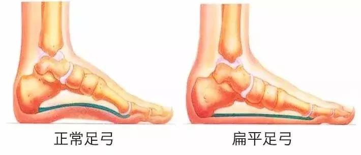 畸形脚型,看脚型分辨你适合穿怎样的鞋子
