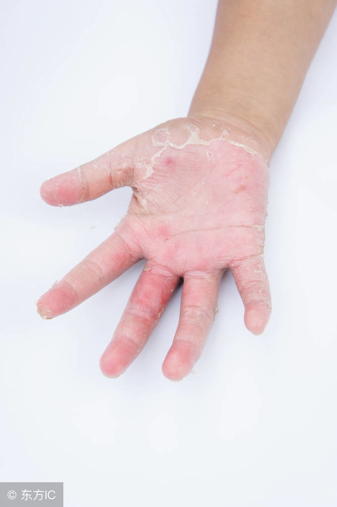 给糖尿病患者的三个忠告,拒绝糖尿病从我做起